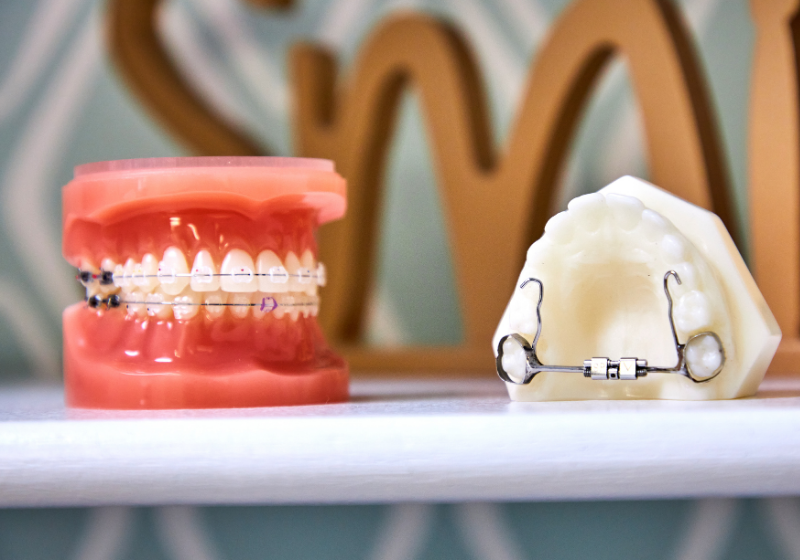 Ceramic Braces