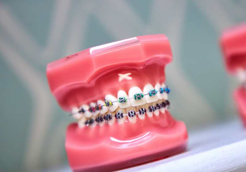 Metal Braces